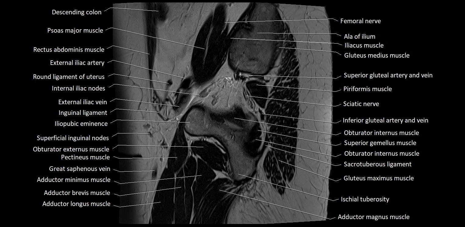 Sagittal cross sectional anatomy of female pelvis (MRI 3T) image 39.webp